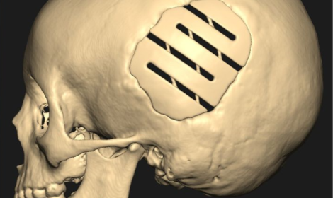 skull implant 2023-12-08 101633.png